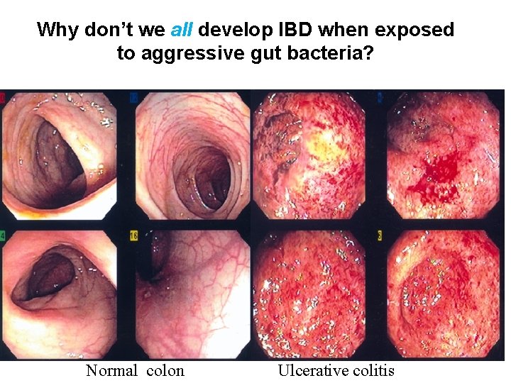 Why don’t we all develop IBD when exposed to aggressive gut bacteria? Normal colon