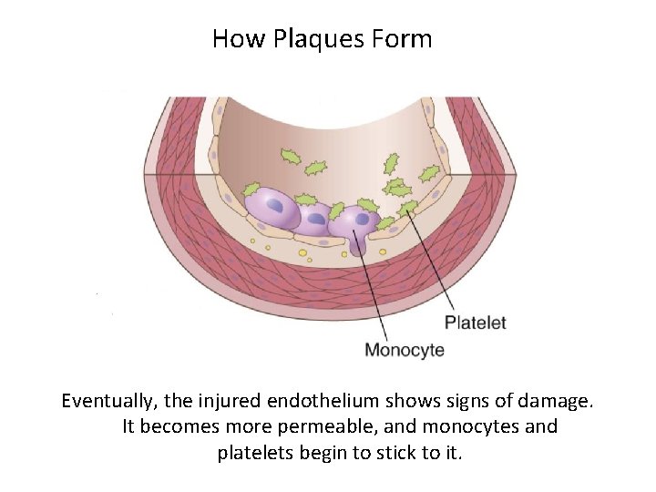 How Plaques Form Eventually, the injured endothelium shows signs of damage. It becomes more