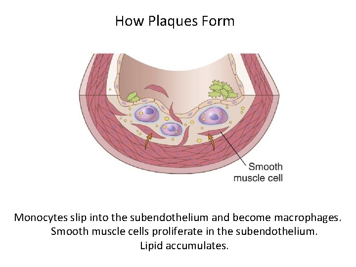 How Plaques Form Monocytes slip into the subendothelium and become macrophages. Smooth muscle cells