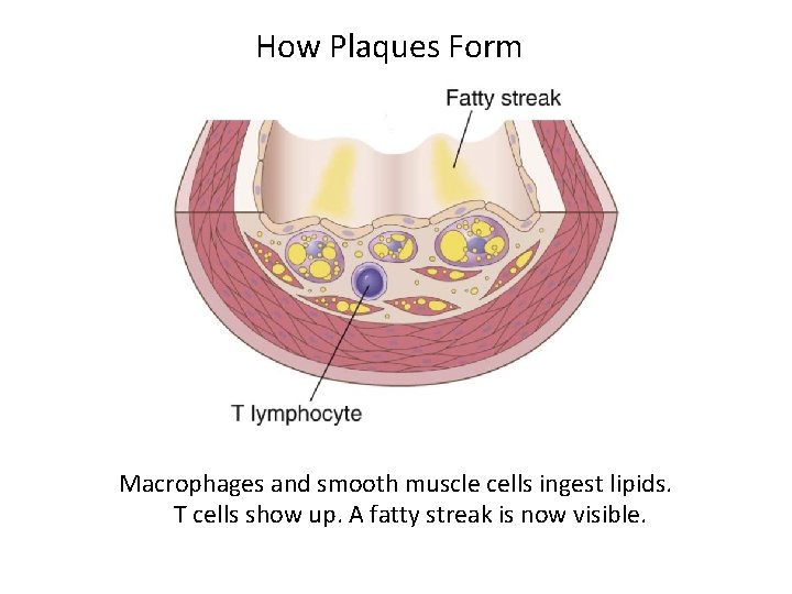 How Plaques Form Macrophages and smooth muscle cells ingest lipids. T cells show up.