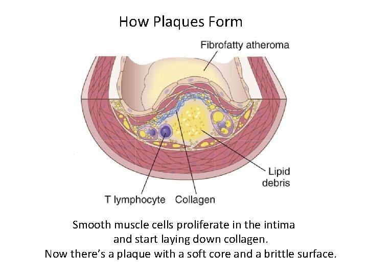 How Plaques Form Smooth muscle cells proliferate in the intima and start laying down