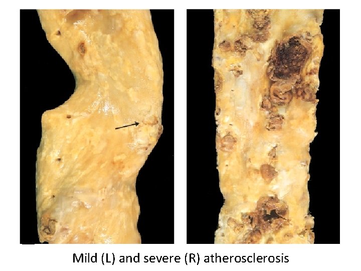 Mild (L) and severe (R) atherosclerosis 