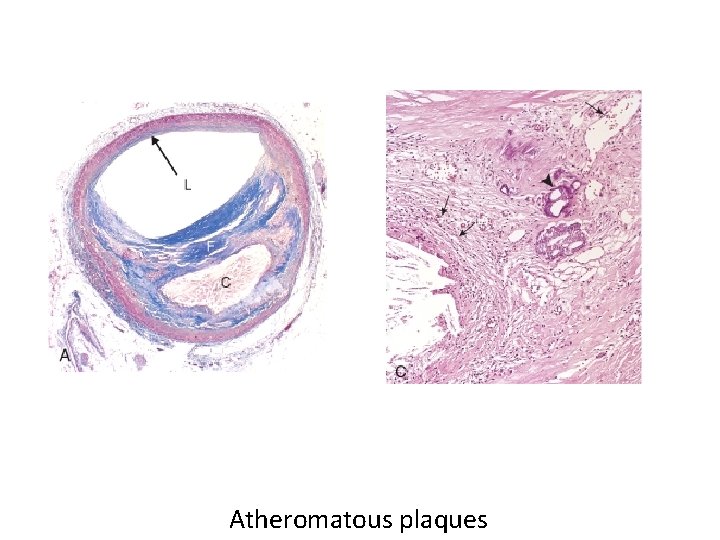 Atheromatous plaques 