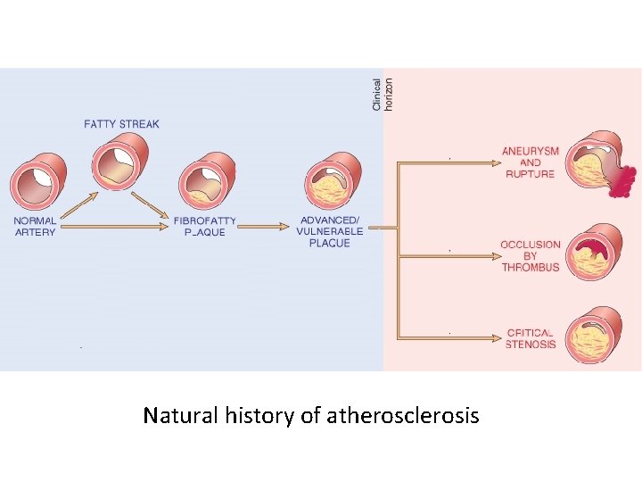 Natural history of atherosclerosis 