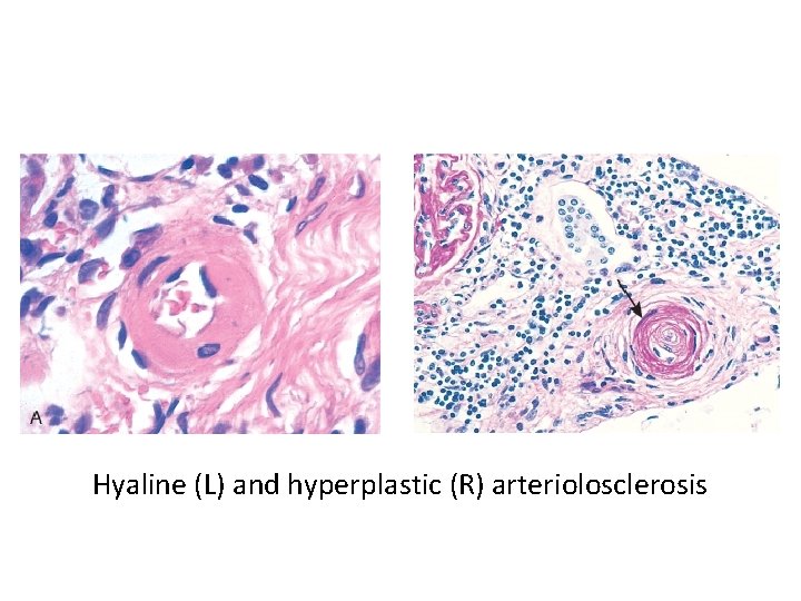 Hyaline (L) and hyperplastic (R) arteriolosclerosis 