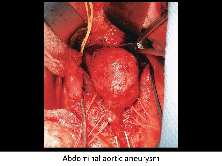 Abdominal aortic aneurysm 
