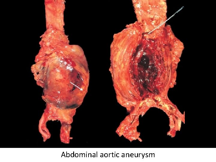 Abdominal aortic aneurysm 