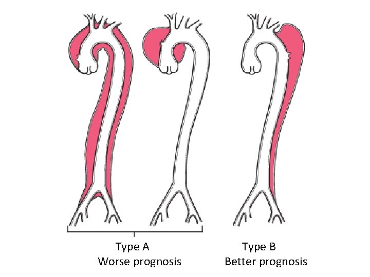 Type A Worse prognosis Type B Better prognosis 