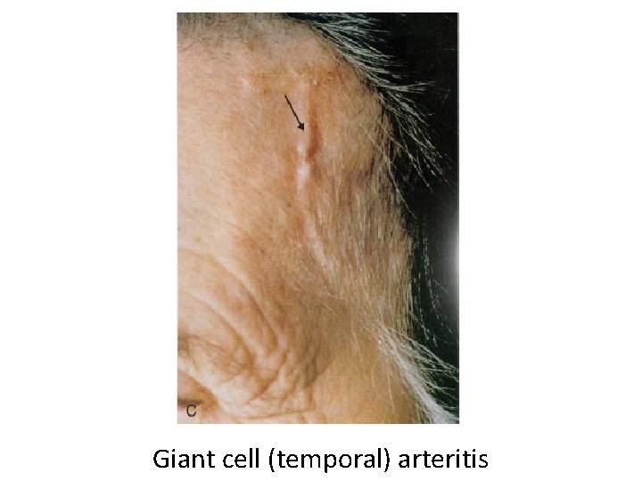 Giant cell (temporal) arteritis 