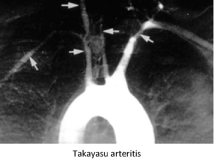 Takayasu arteritis 