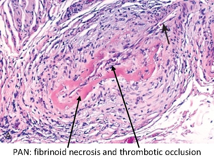 PAN: fibrinoid necrosis and thrombotic occlusion 