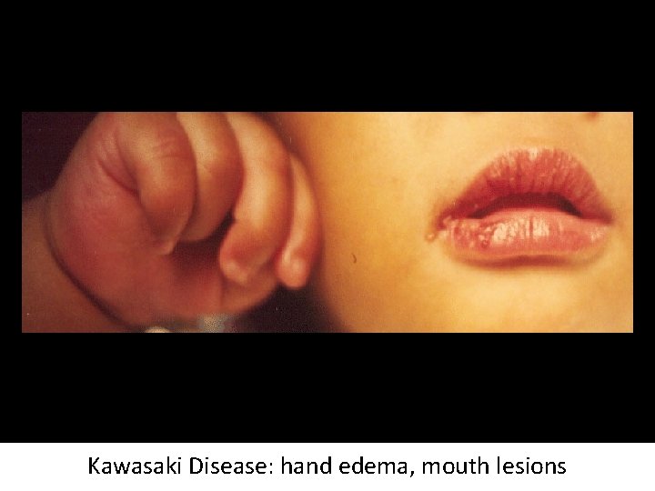 Kawasaki Disease: hand edema, mouth lesions 