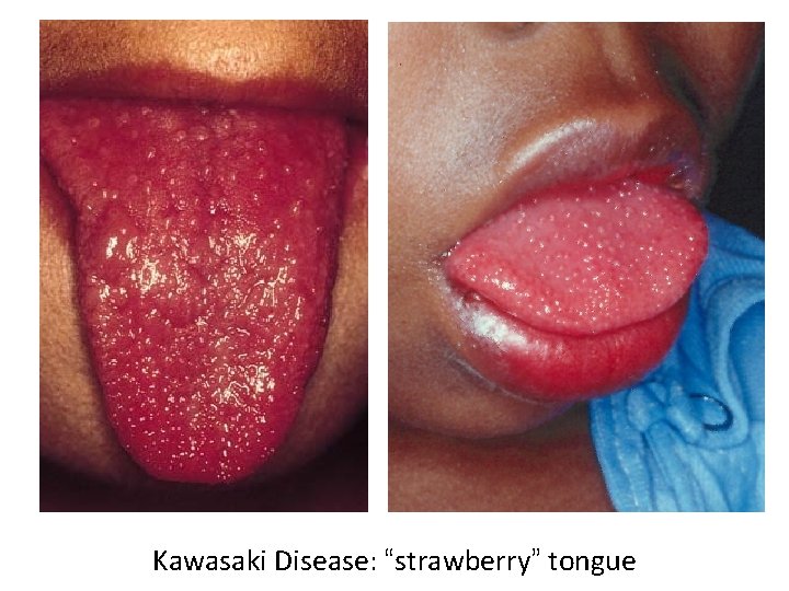 Kawasaki Disease: “strawberry” tongue 