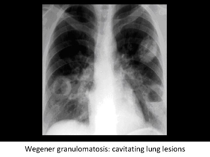 Wegener granulomatosis: cavitating lung lesions 