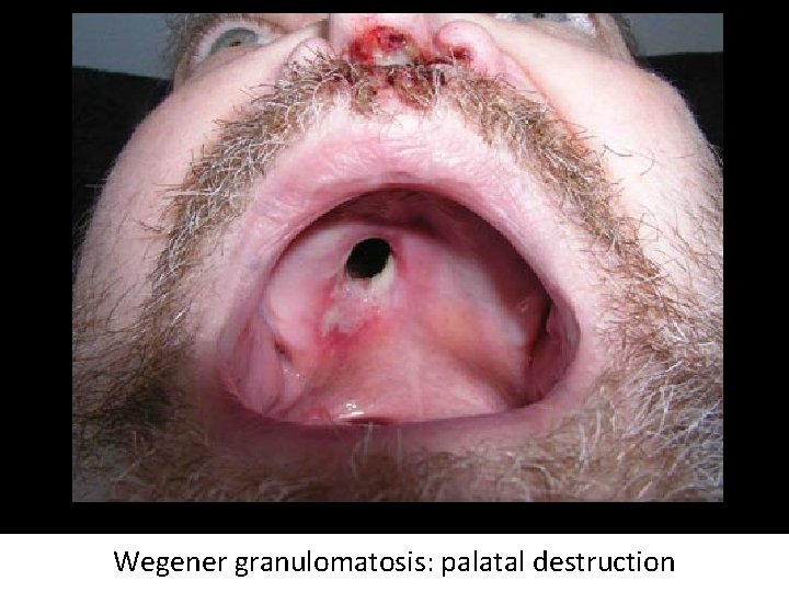 Wegener granulomatosis: palatal destruction 