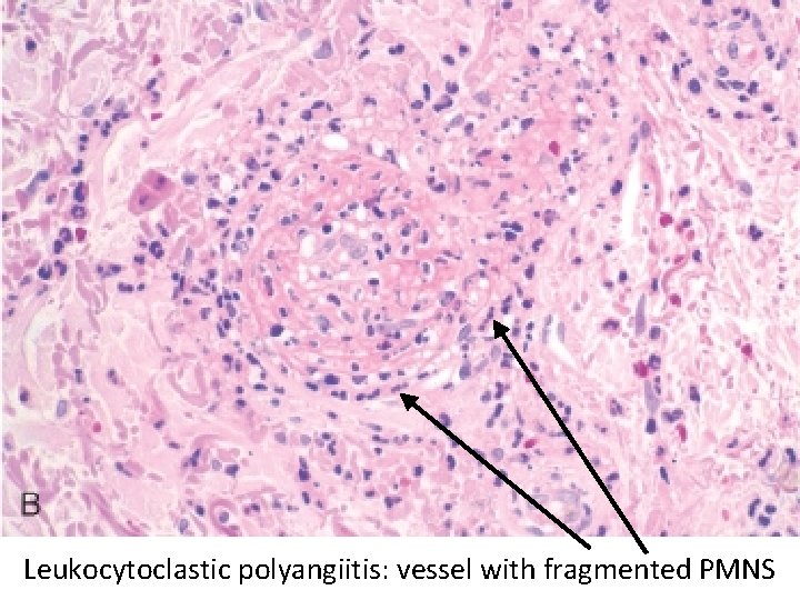 Leukocytoclastic polyangiitis: vessel with fragmented PMNS 