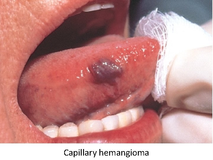 Capillary hemangioma 