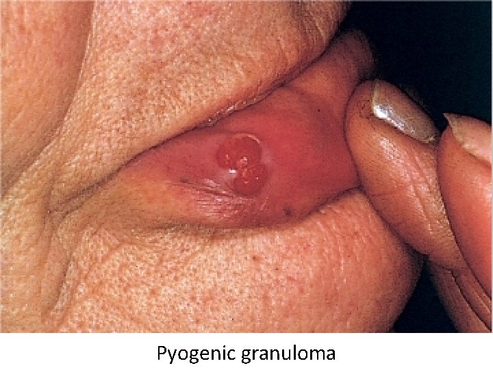 Pyogenic granuloma 