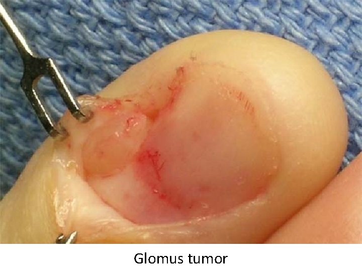 Glomus tumor 