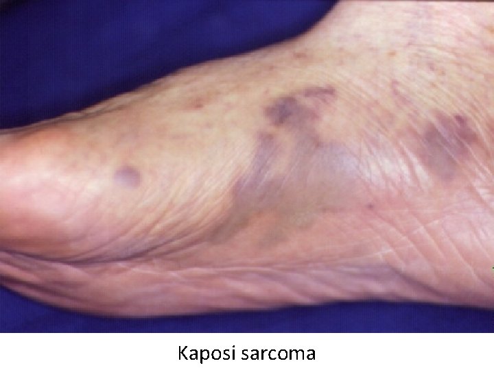 Kaposi sarcoma 