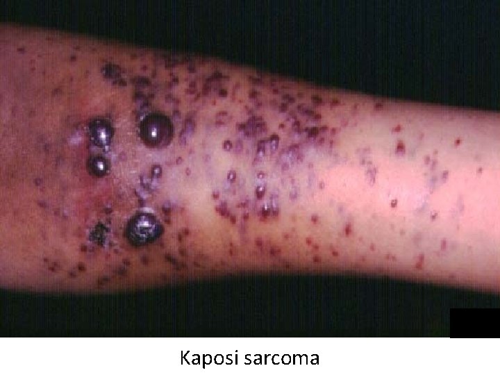 Kaposi sarcoma 