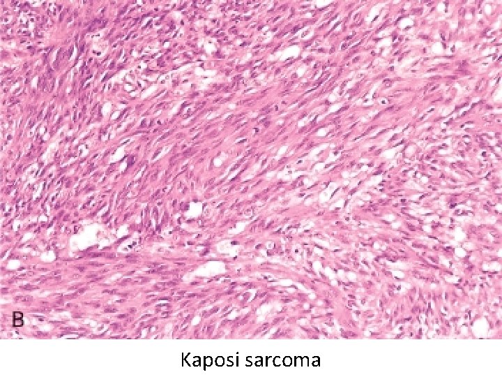 Kaposi sarcoma 