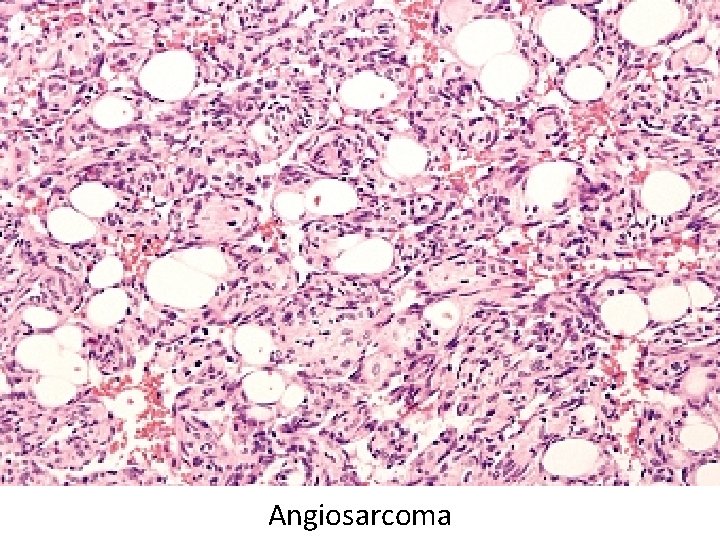 Angiosarcoma 