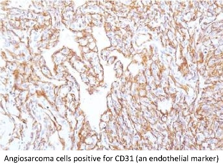 Angiosarcoma cells positive for CD 31 (an endothelial marker) 