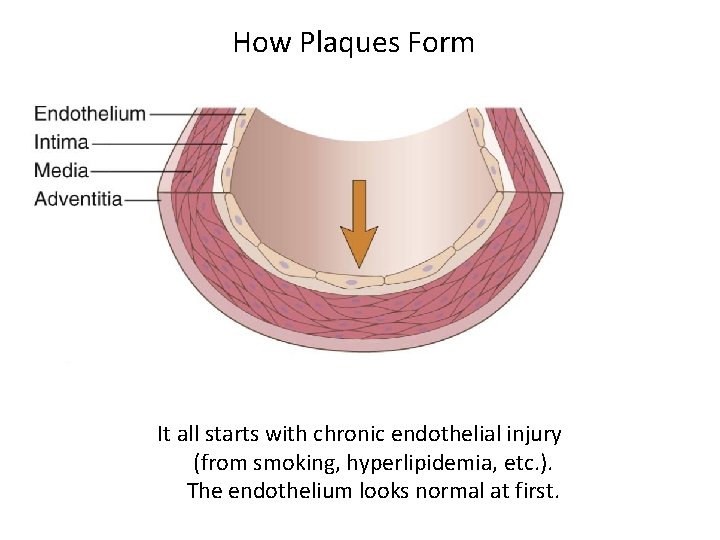 How Plaques Form It all starts with chronic endothelial injury (from smoking, hyperlipidemia, etc.