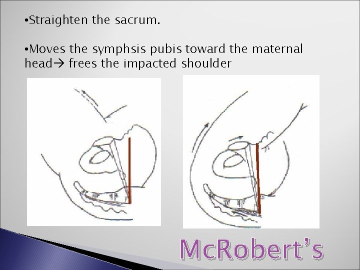  • Straighten the sacrum. • Moves the symphsis pubis toward the maternal head