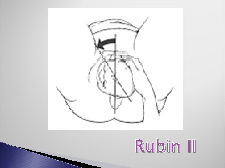 Rubin II 