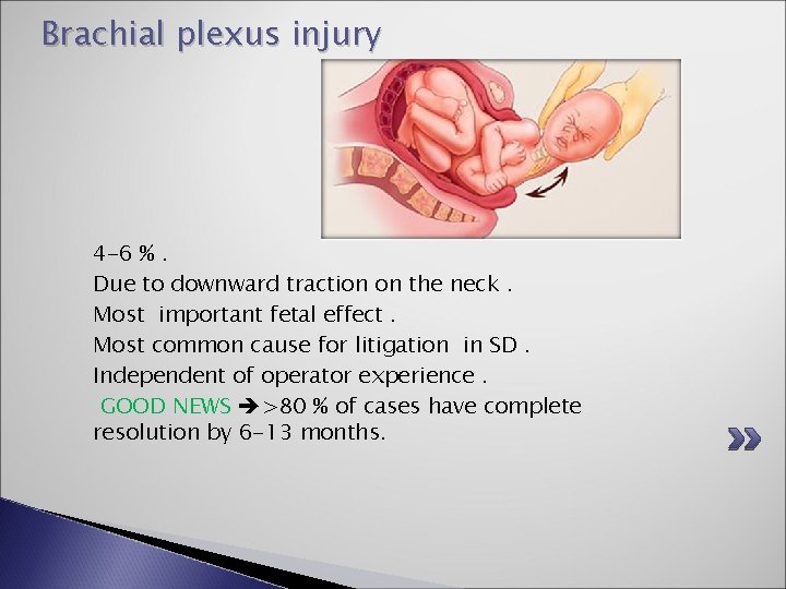 Brachial plexus injury 4 -6 %. Due to downward traction on the neck. Most