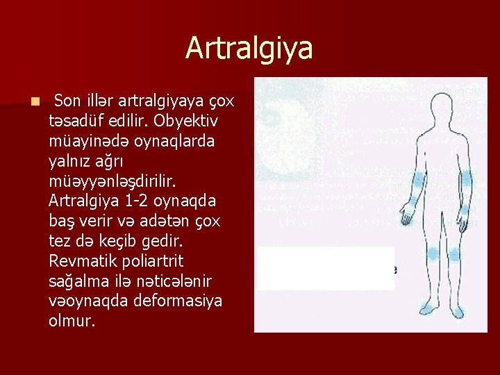 Artralgiya n Son illər artralgiyaya çox təsadüf edilir. Obyektiv müayinədə oynaqlarda yalnız ağrı müəyyənləşdirilir.