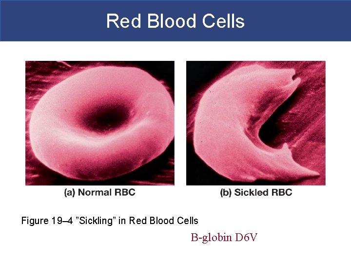 Red Blood Cells Figure 19– 4 ”Sickling” in Red Blood Cells B-globin D 6