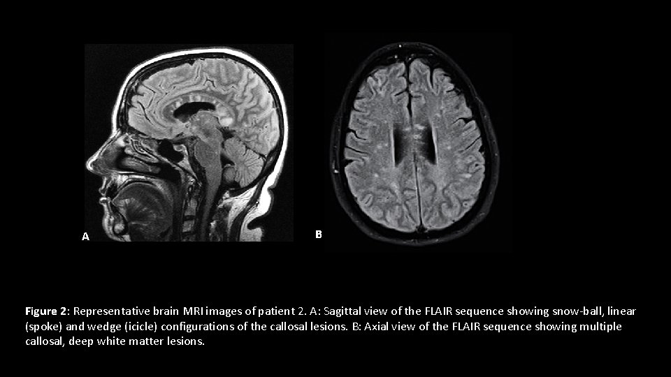 A B Figure 2: Representative brain MRI images of patient 2. A: Sagittal view