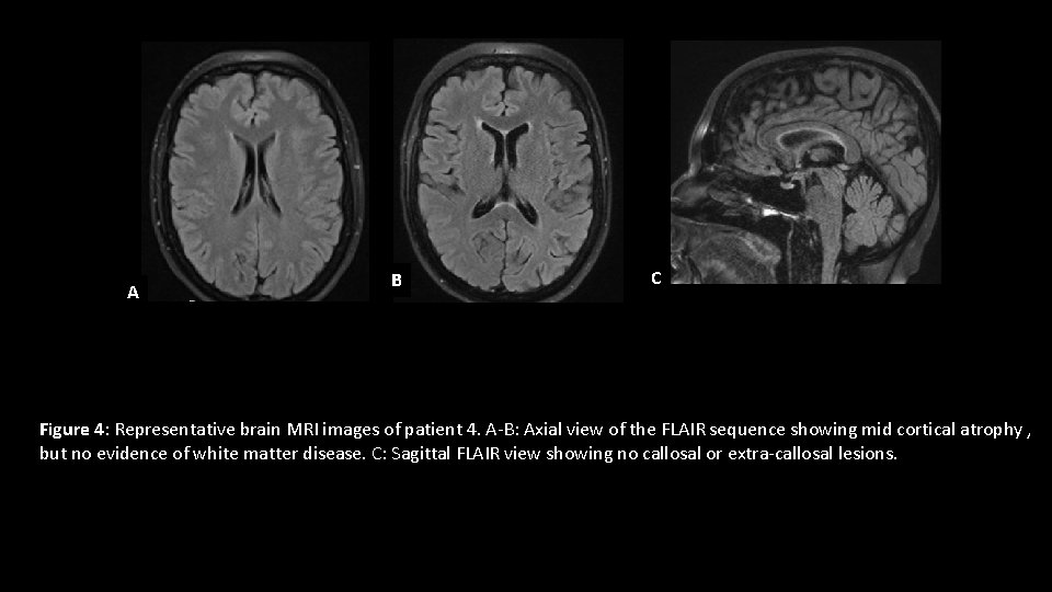 A B C Figure 4: Representative brain MRI images of patient 4. A-B: Axial