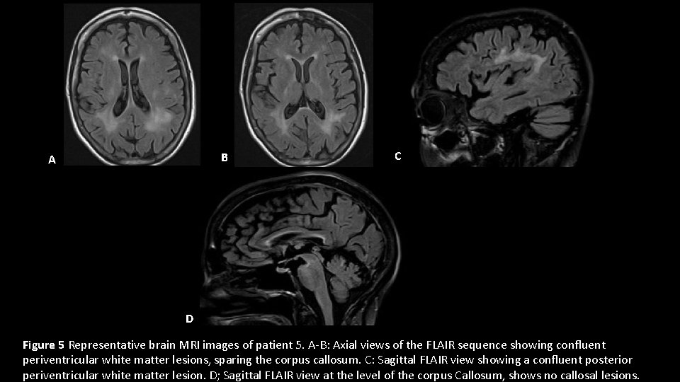 B A C D Figure 5 Representative brain MRI images of patient 5. A-B: