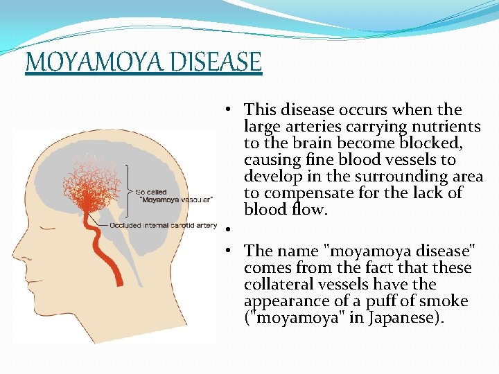 MOYA DISEASE • This disease occurs when the large arteries carrying nutrients to the