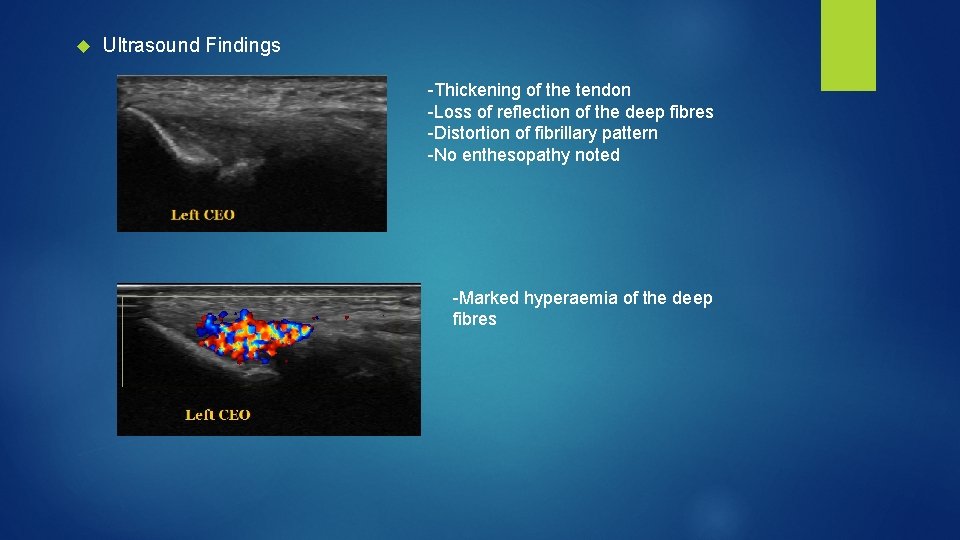  Ultrasound Findings -Thickening of the tendon -Loss of reflection of the deep fibres