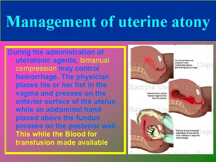 Management of uterine atony During the administration of uterotonic agents, bimanual compression may control