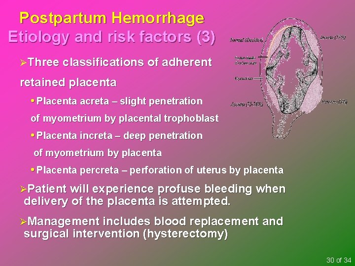 Postpartum Hemorrhage Etiology and risk factors (3) ØThree classifications of adherent retained placenta •