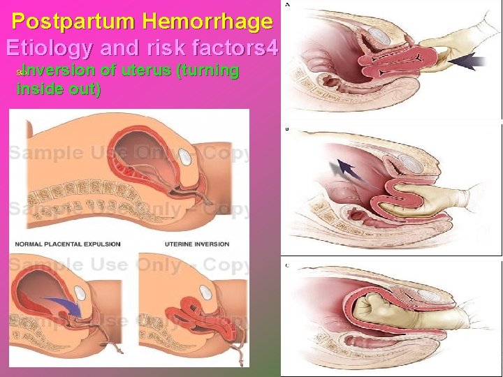 Postpartum Hemorrhage Etiology and risk factors 4 Inversion of uterus (turning inside out) 