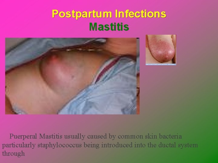 Postpartum Infections Mastitis Puerperal Mastitis usually caused by common skin bacteria particularly staphylococcus being