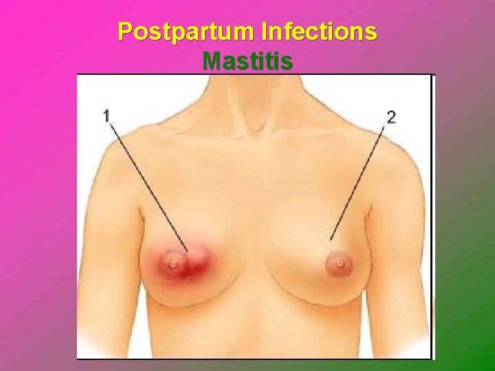 Postpartum Infections Mastitis 