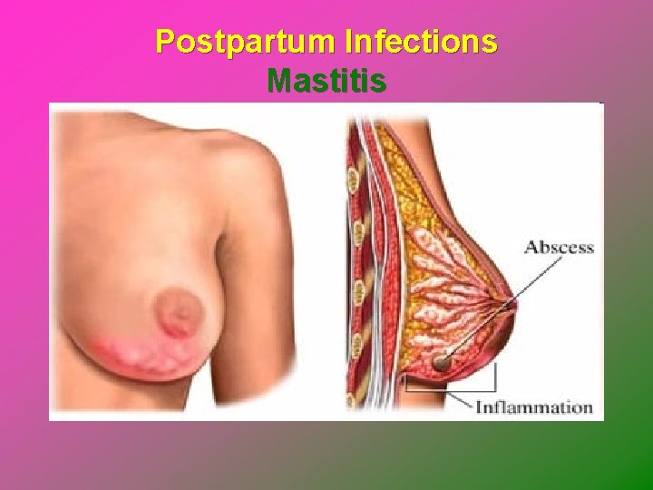 Postpartum Infections Mastitis 