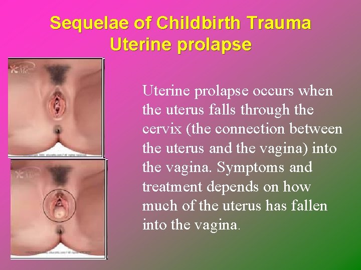 Sequelae of Childbirth Trauma Uterine prolapse occurs when the uterus falls through the cervix