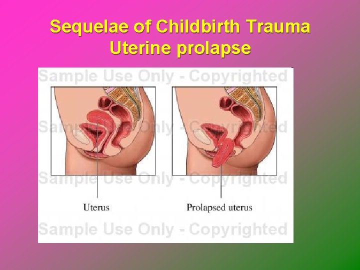 Sequelae of Childbirth Trauma Uterine prolapse 