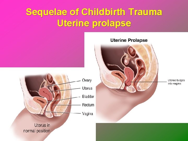 Sequelae of Childbirth Trauma Uterine prolapse 