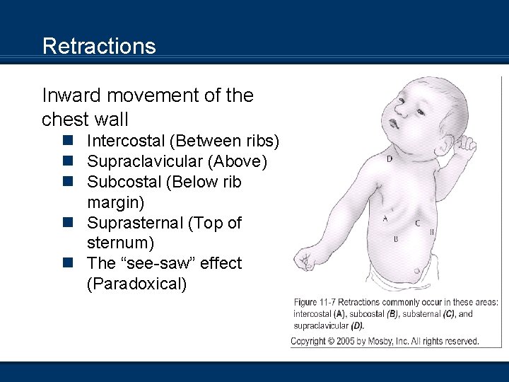 Retractions Inward movement of the chest wall n Intercostal (Between ribs) n Supraclavicular (Above)