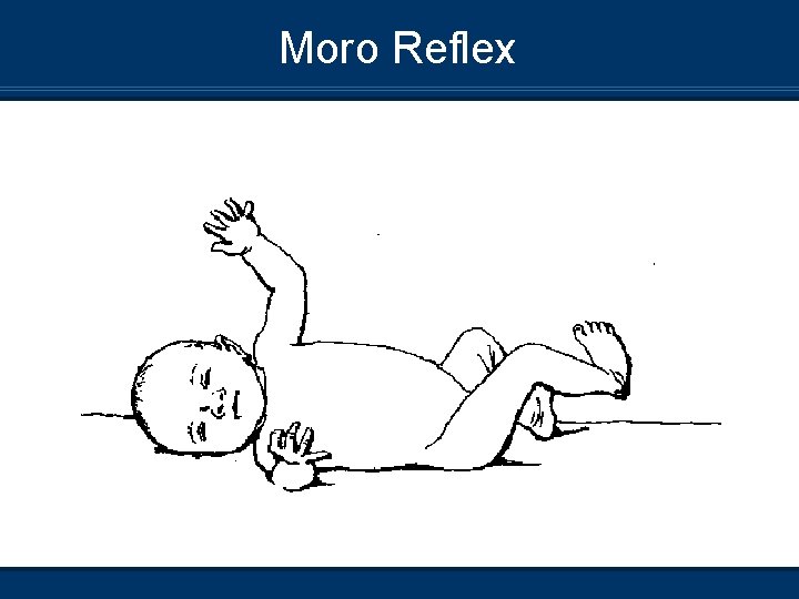 Moro Reflex 